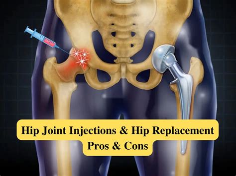 Hip Joint Injections And Hip Replacement Pros And Cons