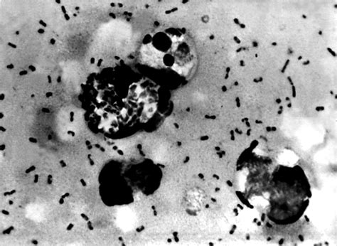 Would We Be Ready To Face An Epidemic Of Bubonic Plague Ramblings