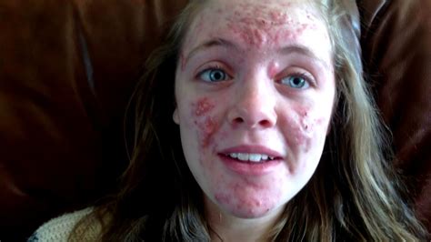The Best Treatment From Dermatologist To Cure And Get Rid Of Severe Acne