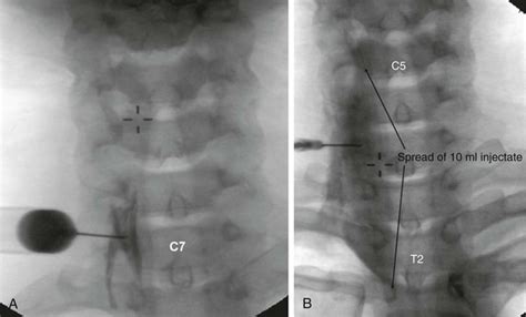 Stellate Ganglion Block Recovery