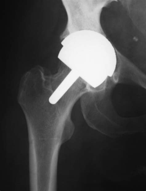 Birmingham Hip Resurfacing Arthroplasty Bone And Joint
