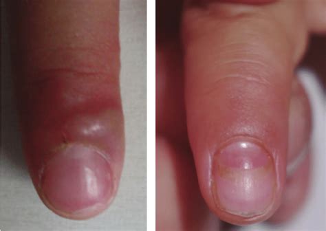 A A Large Pustule Existed Around The Nail Of The Right Index Finger