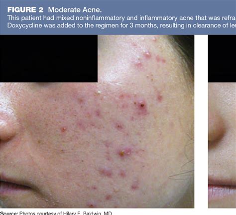 Mild Acne Vs Moderate Acne Quasix Cram Gel Mild To Moderate Acne Care