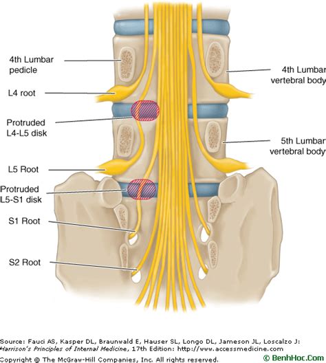 If you are working towards l5 s1 disc herniation recovery, you need to make sure that you are seeing progress. L5 S1 Nerve Root Compression. | 근육, 건강
