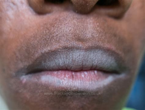 Lip Lickers Dermatitis — Black And Brown Skin