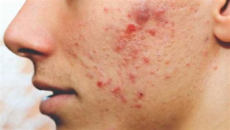 Causes Of Pimples Filled With Blood Treatment And Home Remedies