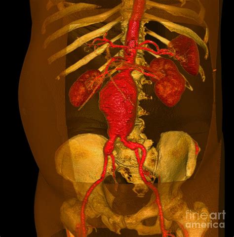 Aortic Aneurysm 3 D Ct Scan Photograph By Du Cane Medical Imaging Ltd