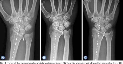 Figure From Factors Affecting The Occurrence Of Distal Radioulnar Joint Arthritis After Ulnar