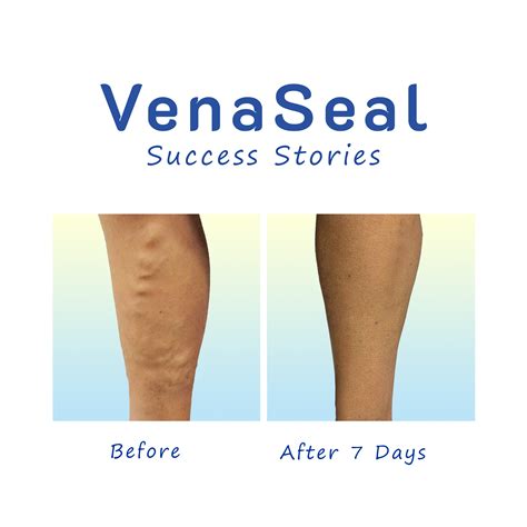 Venaseal Success Before After Pics 2023 The Vein Center Navi Mumbai