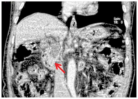 Successful Treatment Of Biliary Intraepithelial Neoplasia In The Common