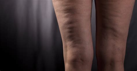 What Is The Difference Between Cellulite And Stretch Marks