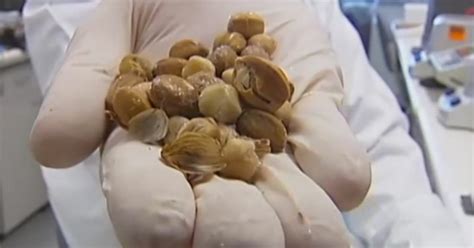 Zinc has been shown in research to inhibit and even kill prostate cancer cells. These unusual berries can kill cancer cells in minutes
