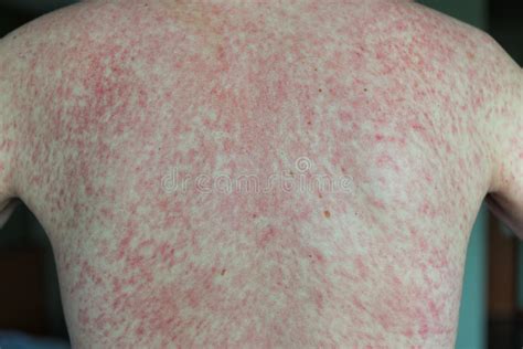 Dengue fever rash characteristics mild itchy rash without fever. Dengue rash. editorial photography. Image of travel, rash ...