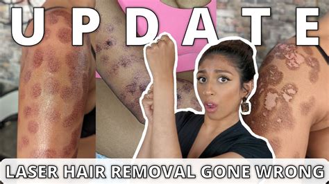 Laser Hair Removal Burn 6 Month Update Eshi Jay Youtube