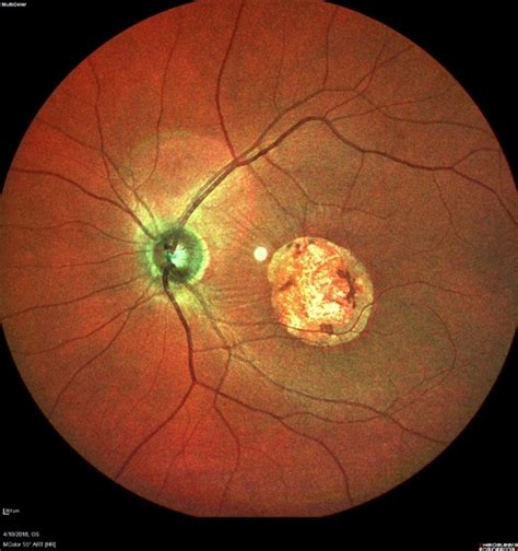 Central Areolar Choroidal Dystrophy Retina Image Bank