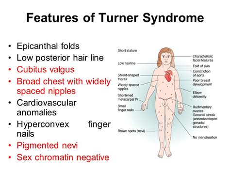 Turner Syndrome Diagnosis And Treatment Faculty Of Medicine