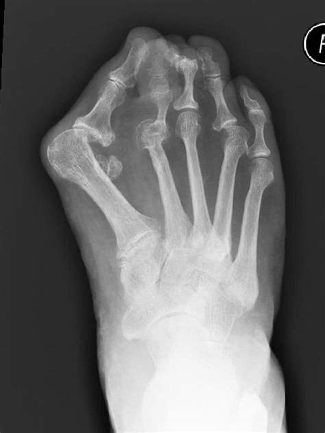 Hallux Valgus Ballenzeh Was Ist Und Wie Wird Behandelt