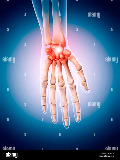 Human Wrist Pain Illustration Stock Photo Alamy