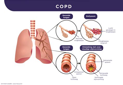 Hoe Weet Ik Of Ik COPD Heb