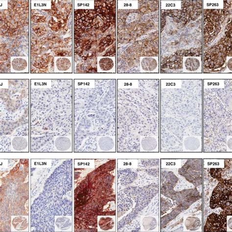 Microphotographs Of Representative Examples Of Ihc Pd L1 Expression By