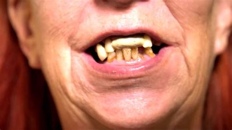 Chewing your food is crucial. Woman uses chewing gum as fake front teeth after avoiding ...