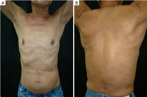 Steatocystoma Multiplex As Initial Impression Of Non Small Cell Lung