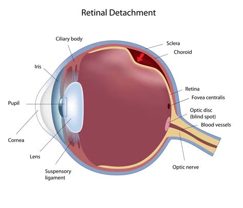 Vitreous Eye Floaters And Retinal Detachment Petrou Eye Care