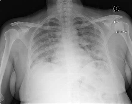 Tension Pneumothorax Radiology Case Radiopaedia Org