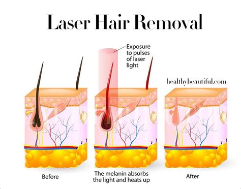 Electrolysis Vs Laser Hair Removal The Complete Guide Healthy