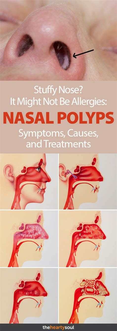 Nasal Polyps Symptoms Causes And Treatments Sinus Infection Symptoms Nasal Allergies Polyp