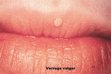 Patología Oral Papilomas Orales Verrugas Orales