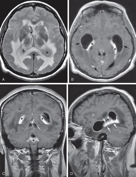 Classical Concepts Of Hydrocephalus Radiology Key