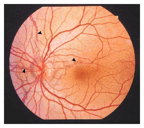 Angioid Streaks In Pseudoxanthoma Elasticum Nejm