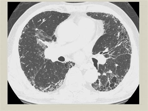 间质性肺疾病的ct诊断