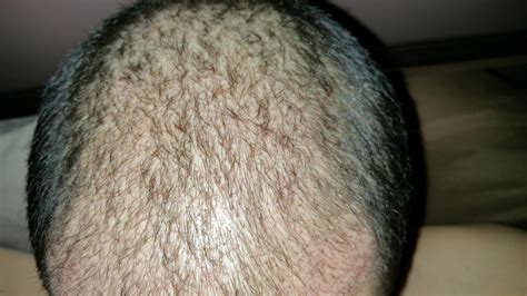 Hair Transplant 6 Weeks After Top My Perfect Image