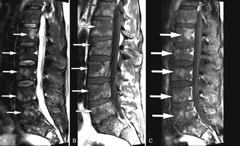 Multiple myeloma is cancer that starts in the bone marrow's plasma cells. Multiple Myeloma | Radiology Key