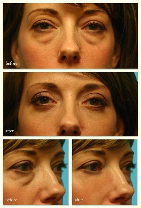 Face yoga does it work before afters graceful face yoga danielle collins the face yoga expert before afters face yoga transformations. Facial Exercises Nose - Gay Ass