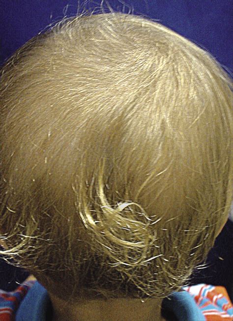 Short anagen syndrome is a cause of abnormally short scalp hair. Practical Guidelines for Evaluation of Loose Anagen Hair ...