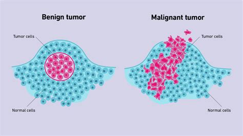 Benign Vs Malignant Tumors Technology Networks