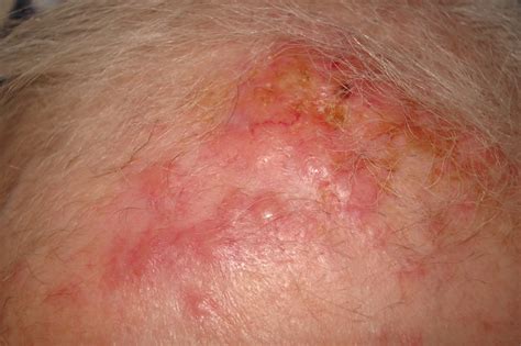 Carcinoid Tumor On Skin