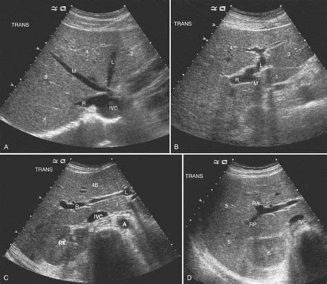 Liver Ultrasound Anatomy