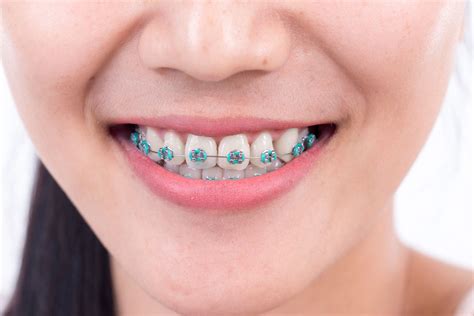 Braces Cost In South Africa
