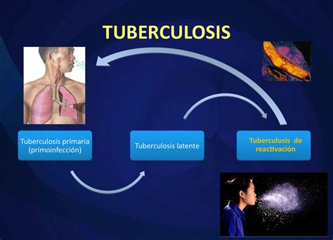 Fases De La Tuberculosis