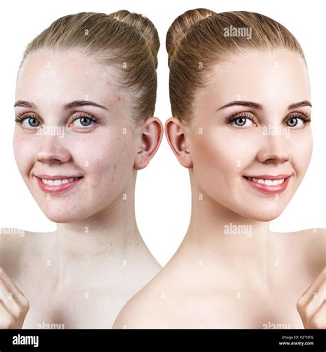 Young Woman With Acne Before And After Retouch Stock Photo 156666372