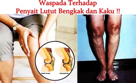 Maybe you would like to learn more about one of these? Pengobatan Tradisional Lutut Bengkak dan Kaku ~ Obat Alami ...