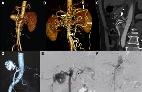 Strategies For Endovascular Treatment Of Complicated Splenic Artery
