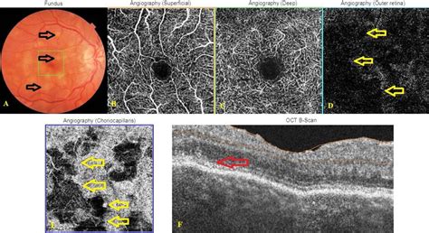 Right Eye Color Fundus Picture Optical Coherence Tomography Oct
