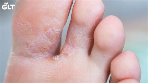 7 Ways To Treat Foot Fungus Easily At Home Youtube