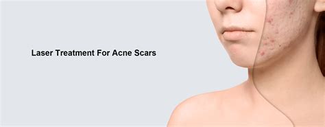 Professional Laser Treatment For Acne Scars Prettylasers