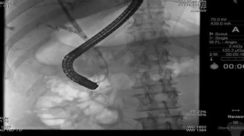 Ercp Removal Of Migrated Cbd Stent Youtube